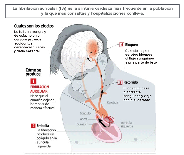 Que es a la tromboflebitis el foro